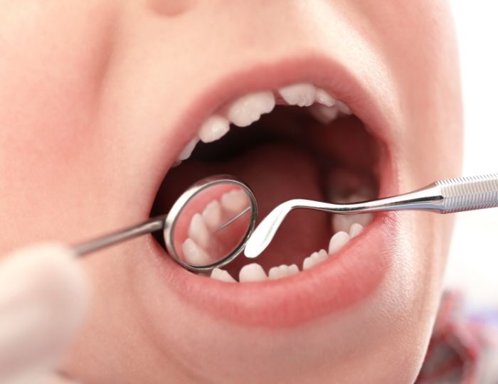子どもの床矯正